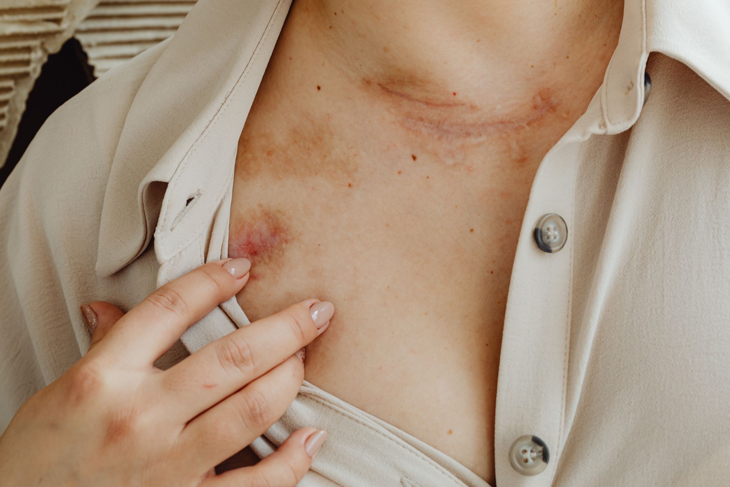 Close-up view of scarred skin on chest with a hand gently touching, symbolizing healing.